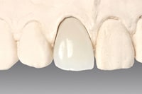 オールセラミッククラウン