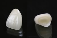 ジルコニアオールセラミックスクラウン