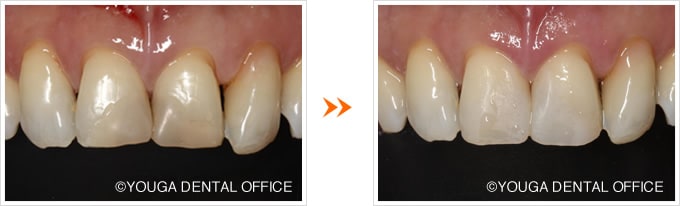 当院のダイレクトボンディングの実症例