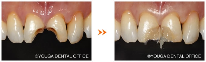 当院のダイレクトボンディングの実症例