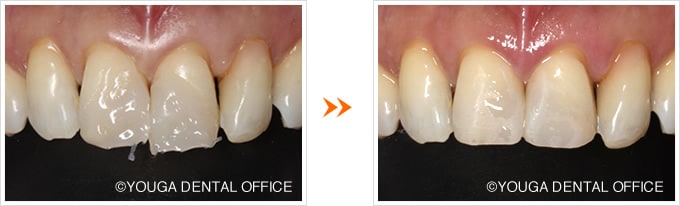 当院のダイレクトボンディングの実症例