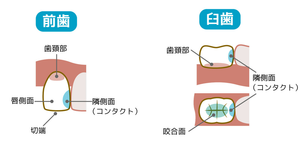 ダイレクトボンディング
