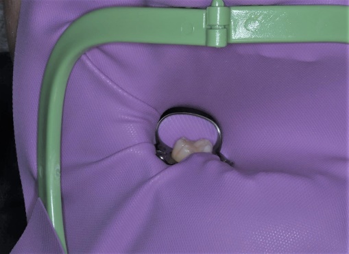 ラバーダム防湿による無菌的処置