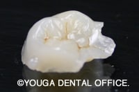 セラミックインレー