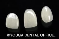 ラミネートベニア