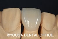 ジルコニアクラウン