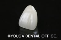 オールセラミッククラウン