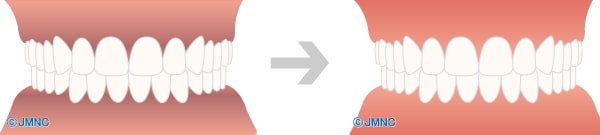 歯ぐきの黒ずみを除去の例