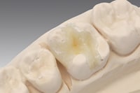 ポーセレンインレー