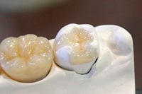 ハイブリッド・インレー