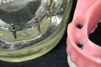 インプラントデンチャー