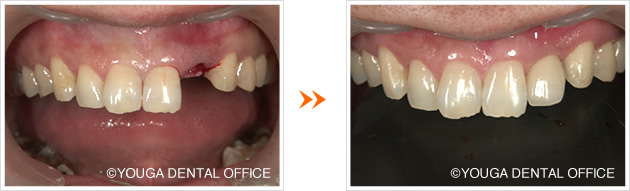 前歯のインプラント