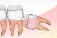斜めに生えている歯