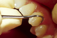 手用スケーラー