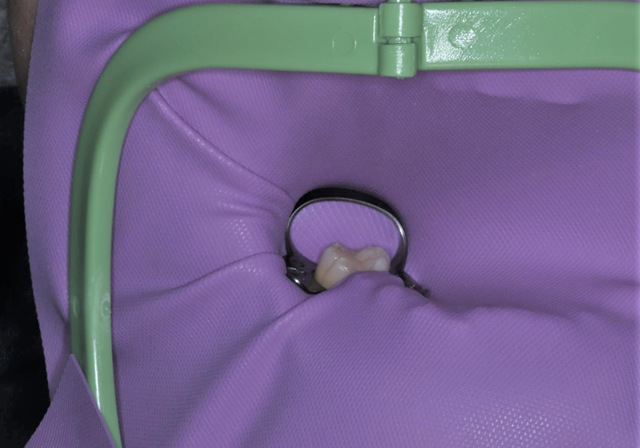 ラバーダム防湿による無菌的処置