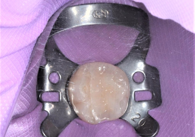 ラバーダム防湿による無菌的処置