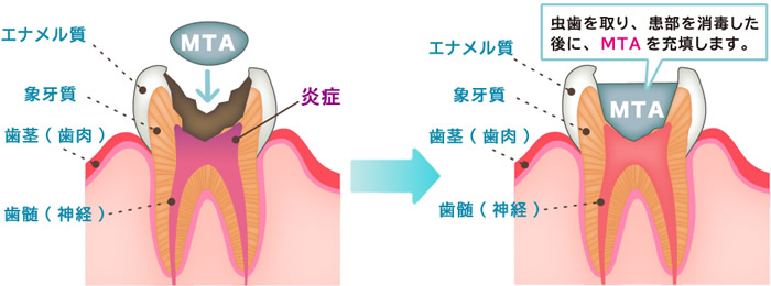 MTAセメントの使い方