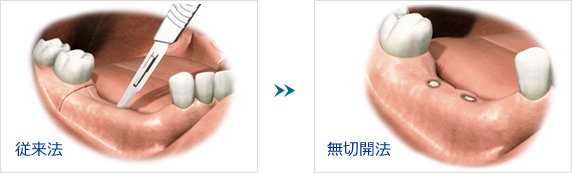 歯ぐきを切らない方法