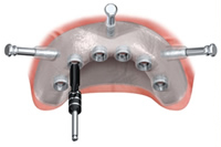 サージカルステント