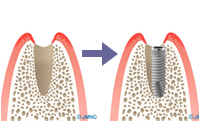 歯を抜いてインプラント