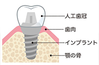 インプラントとは？