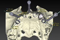 安全・確実な治療のためのガイドサージェリー