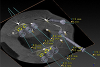 安全・確実な治療のためのガイドサージェリー