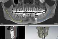 理由4．CT診断による安全に配慮したインプラント