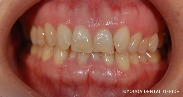 インビザビフォー