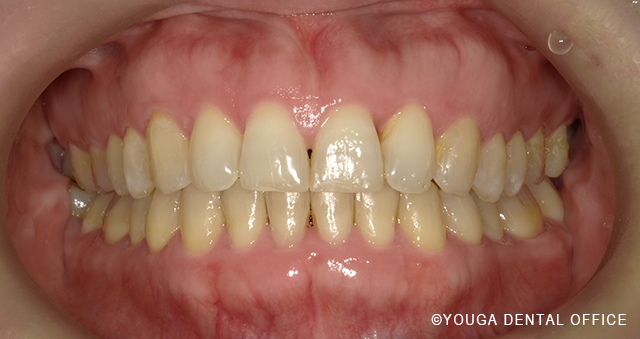 インビザアフター