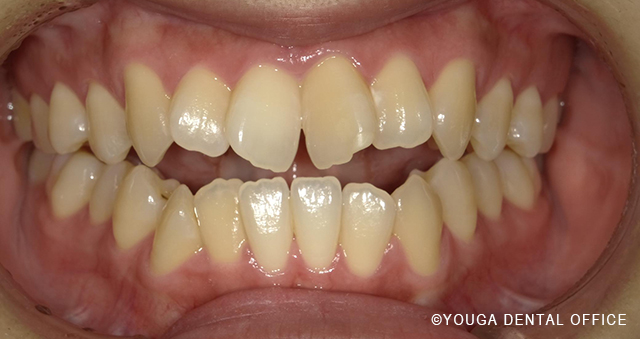 インビザビフォー