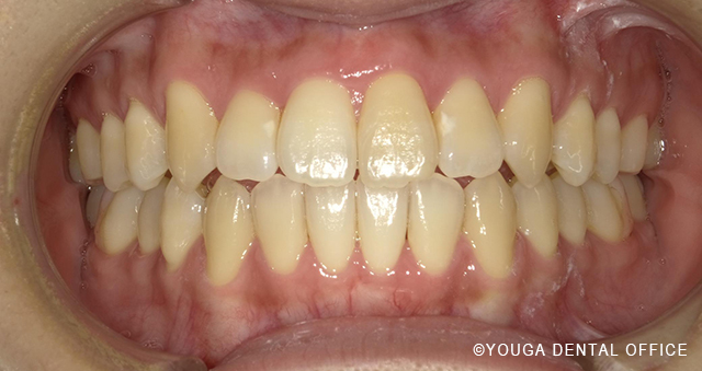 インビザアフター