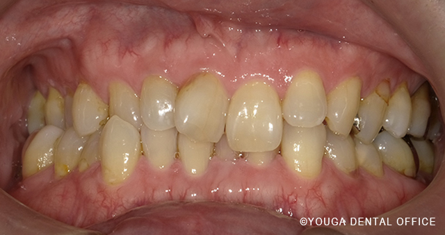 インビザビフォー