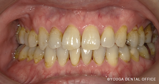 インビザアフター