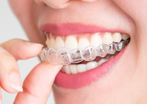 インビザライン