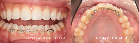 部分矯正装置・表側と裏側