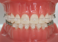 目立たない矯正