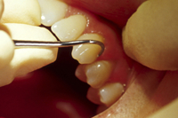 歯石除去