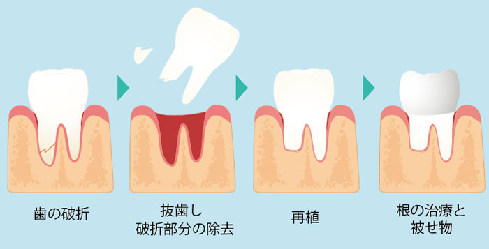 意図的再植治療