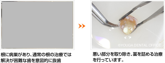 意図的再植治療とは