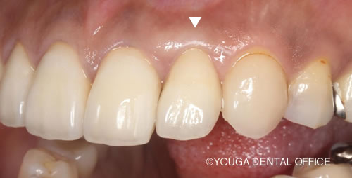 オールセラミッククラウン