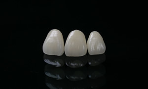 オールセラミッククラウン