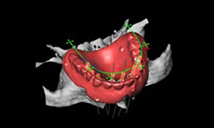 CT撮影・3D診断インプラント