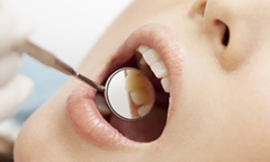 虫歯・歯周病・親知らず