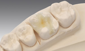 セラミックインレー