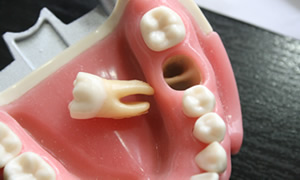 歯が抜けた・グラグラする