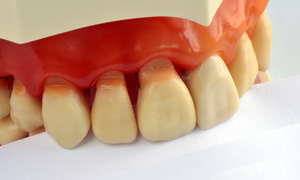 歯ぐきが下がる 後退してきた