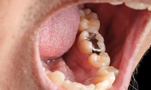 銀歯を白くしたい