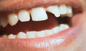 前歯が欠けた・折れた