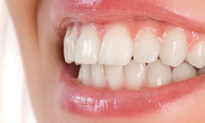 歯を白くしたい、黄ばみ・着色